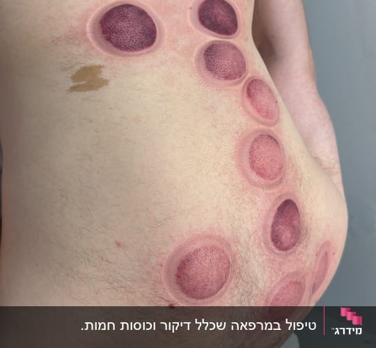 סימני כוסות רוח על גבו של מטופל בקליניקה לרפואה סינית